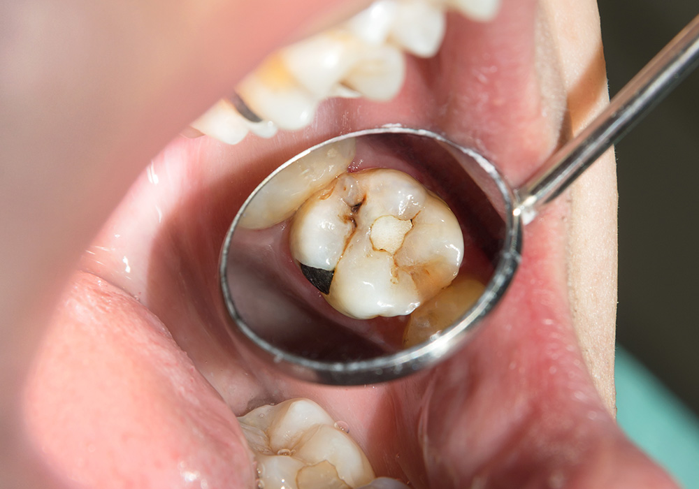 ①むし歯が再発しにくくなる