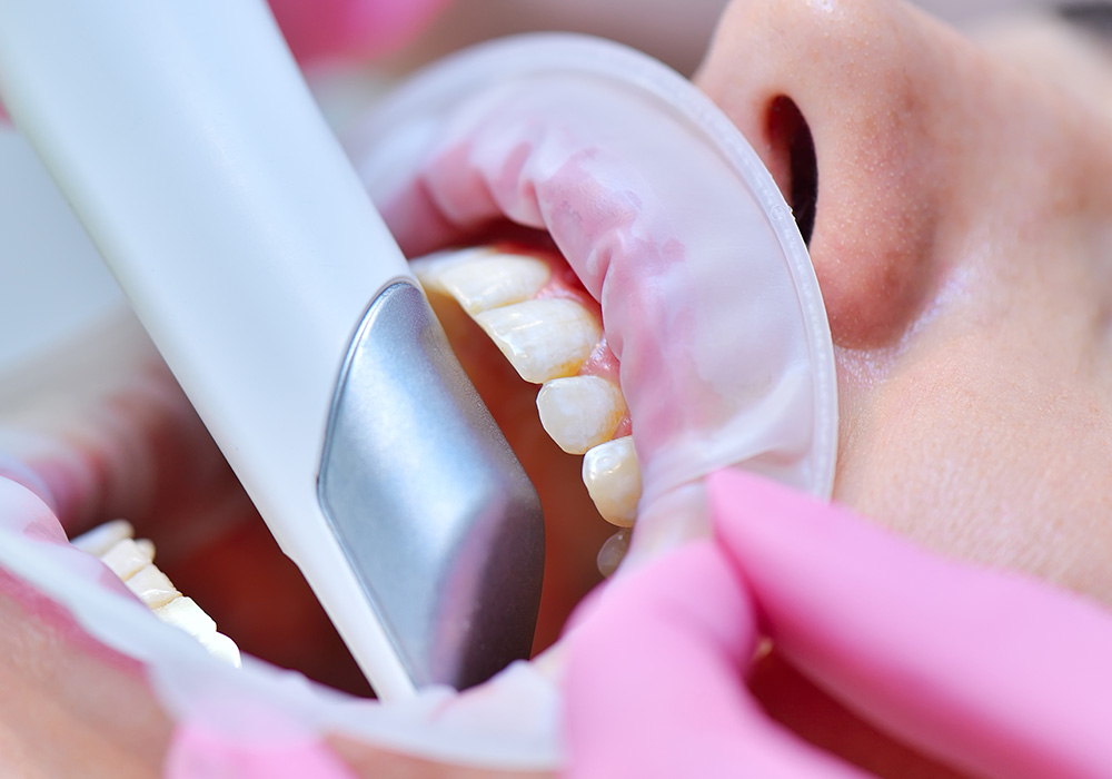 スキャン(型取り)